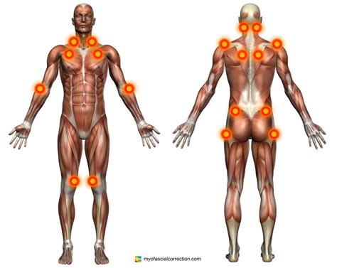 Fibromyalgia Tender Points - Plymouth Chiropractor