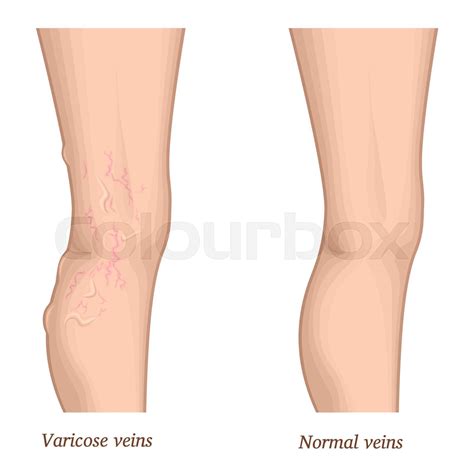 Varicose Vein In Umbilical Cord