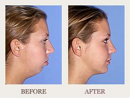 Receding Chin? BOTOX® Might Be A Solution - Dr. Robert Kotler