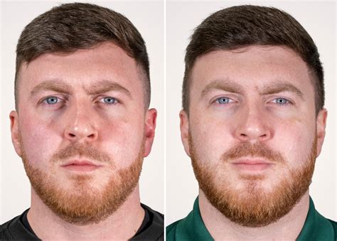Seventy Hyal Before and After: The Results | Seventy Hyal 2000