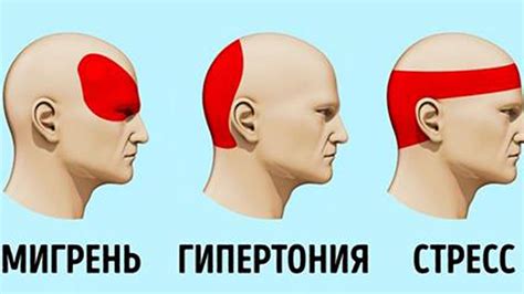 Как избавиться от головной боли без таблеток за 5 минут