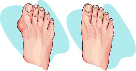 ZagrebMed - Effective Hallux Valgus Treatment in Zagreb - Choose