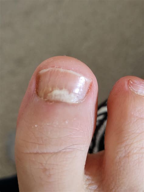 Please help. What is this ?does it look like fungus nail infection