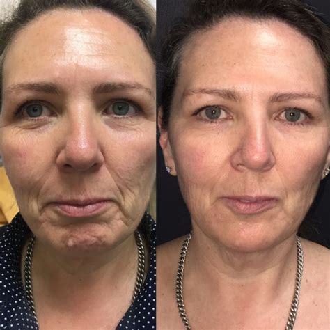 Non Surgical Face Lift For Jowls at Chantay Mccormick blog