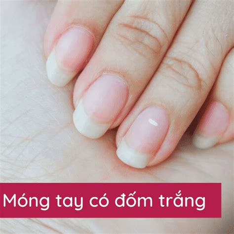 Móng Tay Có Đốm Trắng Cảnh Báo Bệnh Gì? Có Đáng Lo? | TIKI