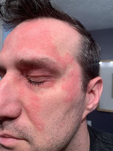 Help Identifying Face Rash : r/Dermatology