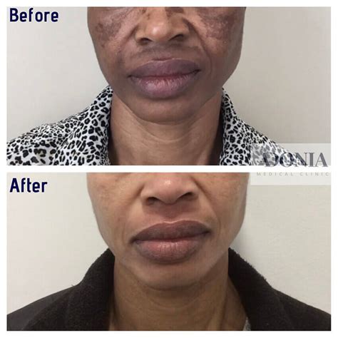 Hyperpigmentation treatment london