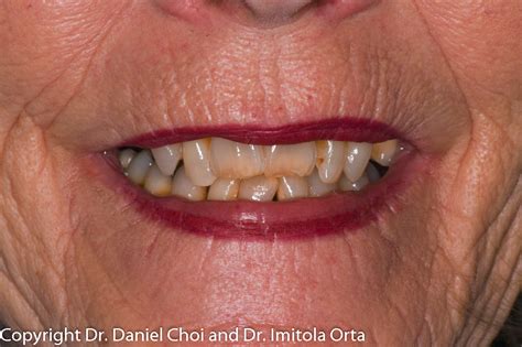 Snap-In Dentures | North Texas Dental Surgery