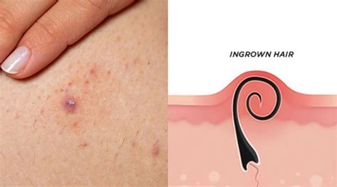 how to get rid of an ingrown hair on leg