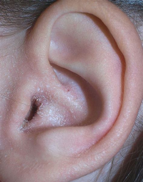 Otitis externa physical examination - wikidoc