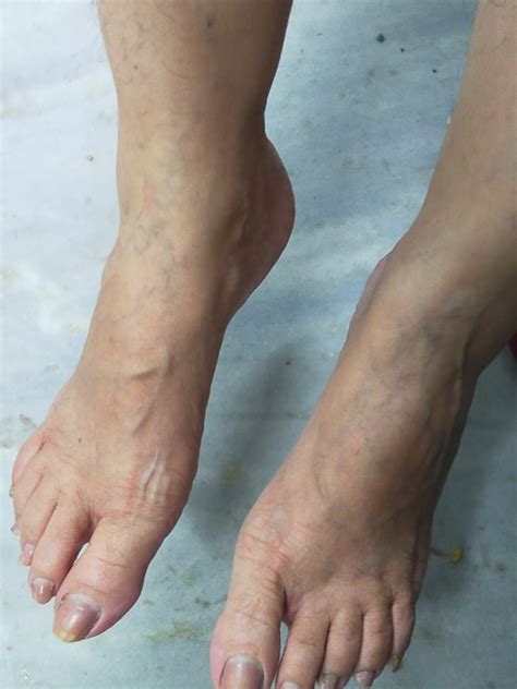 Gangrene Treatment by Dr. Kumar
