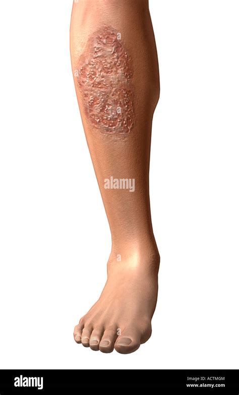 Pyoderma gangrenosum hi-res stock photography and images - Alamy