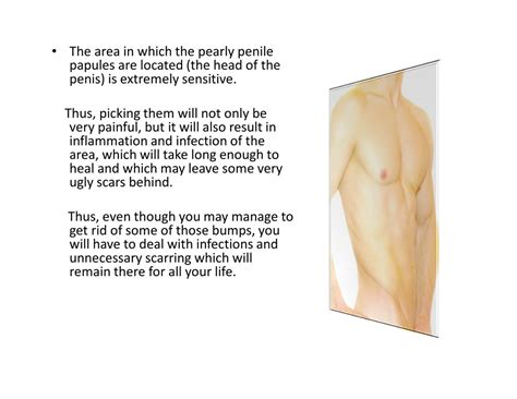 PPT - Pearly Whites, Anaesthetic Cream For Ppp, Pearly Penile Papules