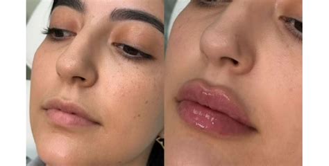 dermal fillers phoenix scottsdale expert injectors beso