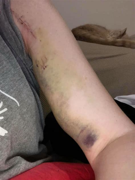 Best 12 Hemi Shoulder Replacement following damage from Lupus and long