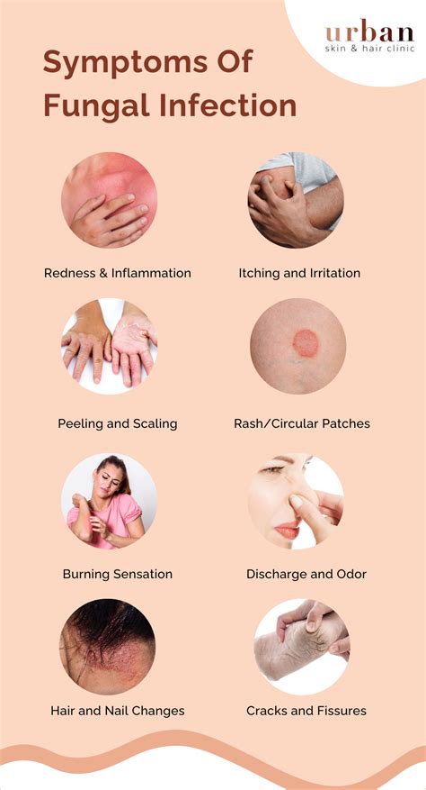 Fungal Infection Types, Causes, Symptoms & Treatment | USHC 