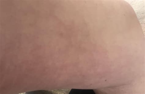Anyone have rashes like this or know what it is?! : r/Autoimmune