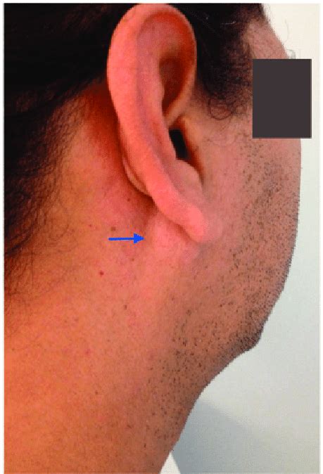 clinical appearance   parotid region    retroauricular