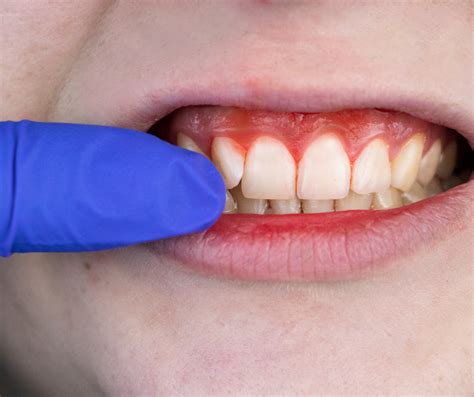 Jak řešit zánět dásní? | OROXID.CZ