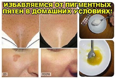 Секреты красоты и здоровья.: ИЗБАВЛЯЕМСЯ ОТ ПИГМЕНТНЫХ ПЯТЕН В ДОМАШНИХ ...