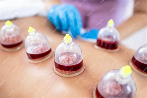 Premium Photo | Hijama wet cupping treatment close up view on cups ...