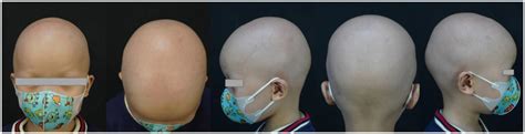 Before dupilumab therapy. | Download Scientific Diagram