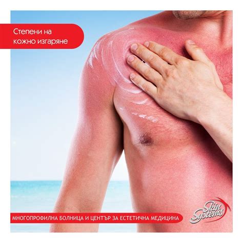 Степени на кожно изгаряне Когато говорим за изгаряне, класифицираме ...