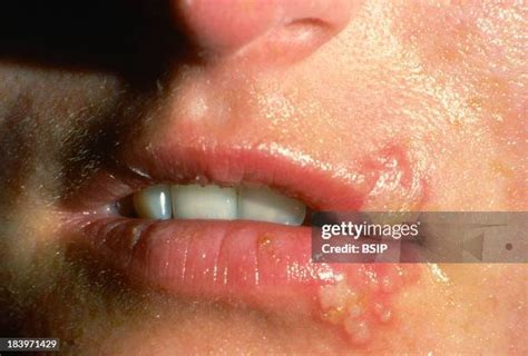 how to know if u have herpes in the mouth