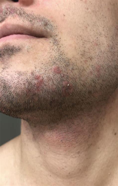 Facial fungus? : r/Dermatology