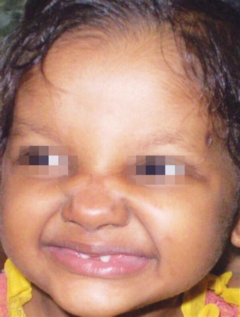 front view showing classical features  child  ectodermal