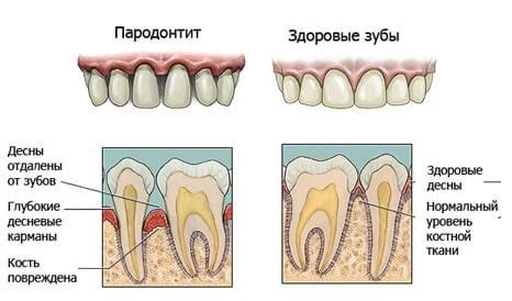 Пародонтит: симптомы, фото, лечение. Как лечить пародонтит