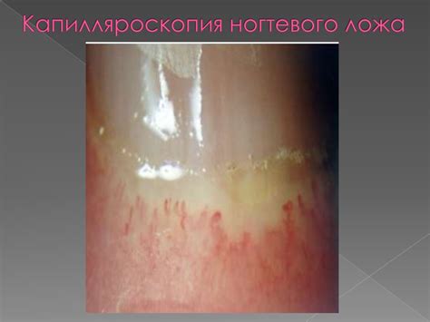 Системная склеродермия - online presentation