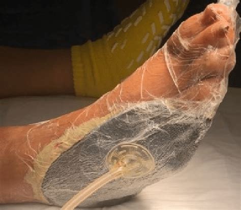 npwt application   healing wound  scientific diagram