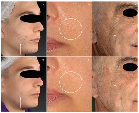 carbon peeling laser treatment  improve skin texture pores  acne