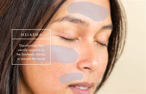 melasma how to remove