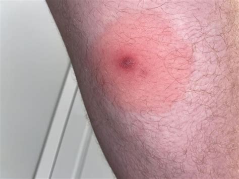 bump   thigh rdermatologyquestions