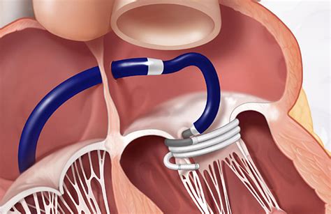 edwards sapien  tmvr system  nitinol