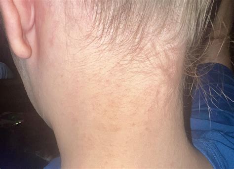 Break out on neck, scalp and ears, very itchy! : r/DermatologyQuestions