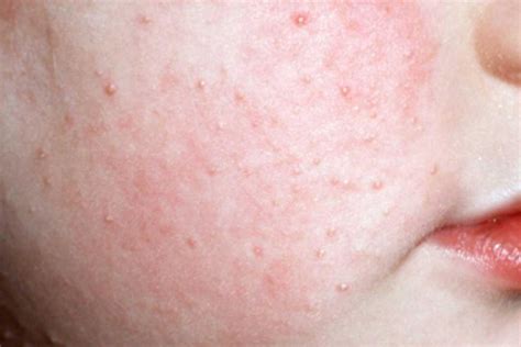 KERATOSIS-PILARIS - Beautyologist