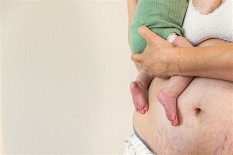 Why C-Section Recovery Deserves Extra Care – Lansinoh UK