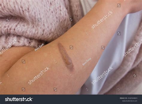 female hand thermal burn skin domestic stock photo