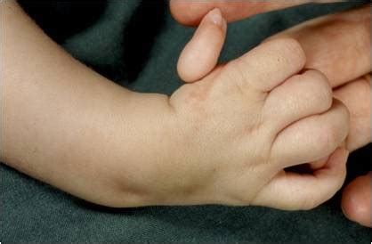 thumb hypoplasia wikipedia