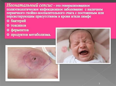 Сепсис новорожденных - презентация онлайн