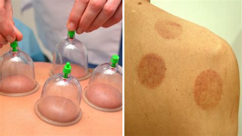 What Is Cupping Treatment? Man Left With Bruises After Cupping | Allure