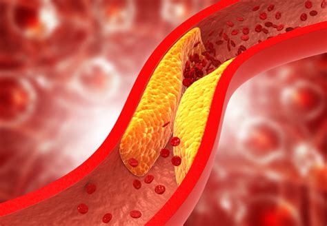 O Que E Arteriosclerose - Arteriosclerose: sintomas, causas e qual especialista procurar
