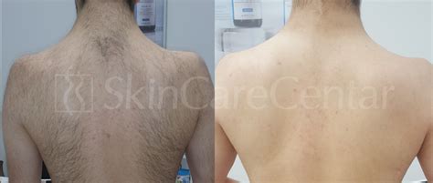 Laserska epilacija – SkinCare Centar