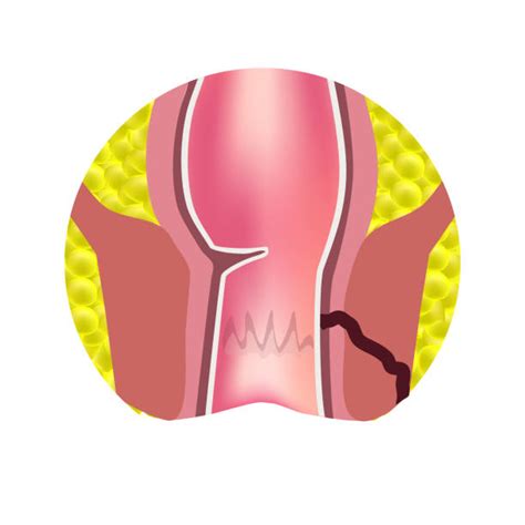 Fistula Illustrations, Royalty-Free Vector Graphics & Clip Art - iStock