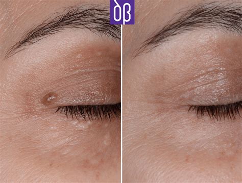 Siringoma Tratamento Antes E Depois
