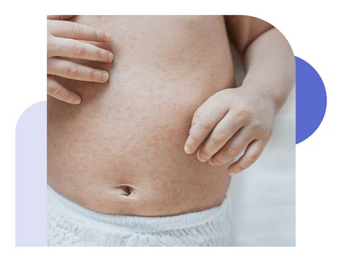 Dr. Anna Chacon | Online dermatologist