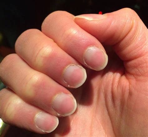 What Causes Red Fingernail Beds Design Talk - vrogue.co